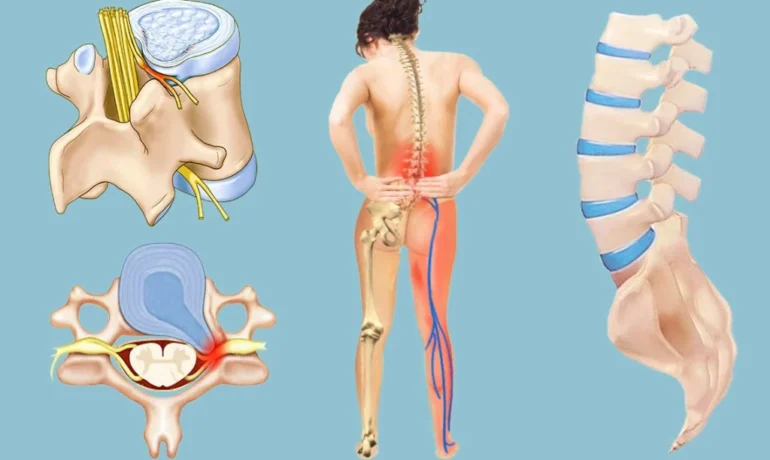 Первые симптомы грыжи