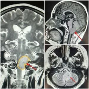 Краниовертебрал ўтиш соҳасидаги менингиома