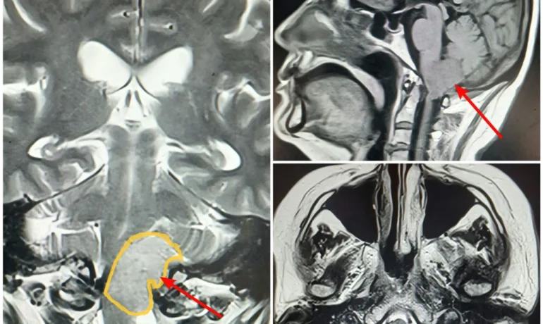 Удаление менингиомы краниовертебрального перехода